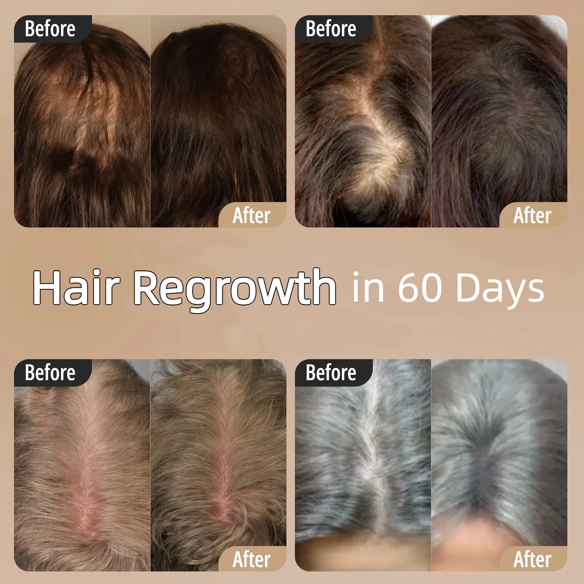 Scalp massager for hair loss